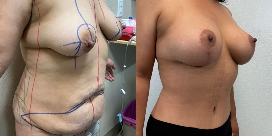 Mommy Makeover - Thumbnail 2