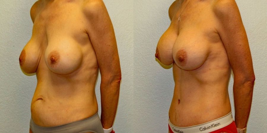 Mommy Makeover - Thumbnail 2