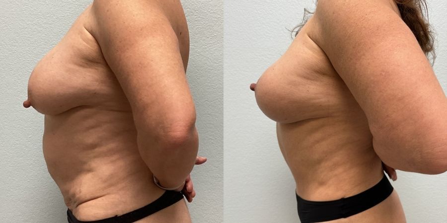 Mommy Makeover - Thumbnail 3