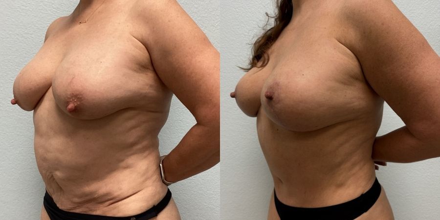 Mommy Makeover - Thumbnail 2