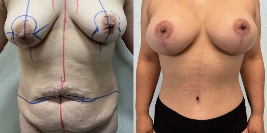 Mommy Makeover - Case 19192