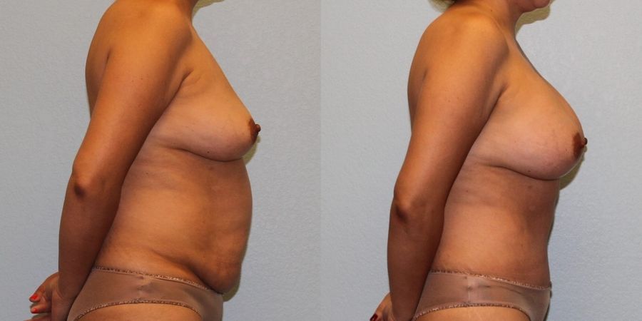 Mommy Makeover - Thumbnail 3