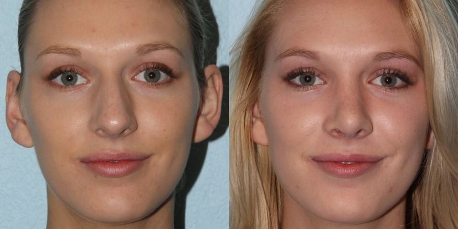 Rhinoplasty - Case 19433