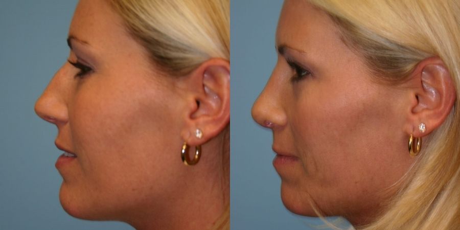 Rhinoplasty - Thumbnail 2