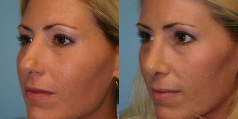 Rhinoplasty - Thumbnail 3