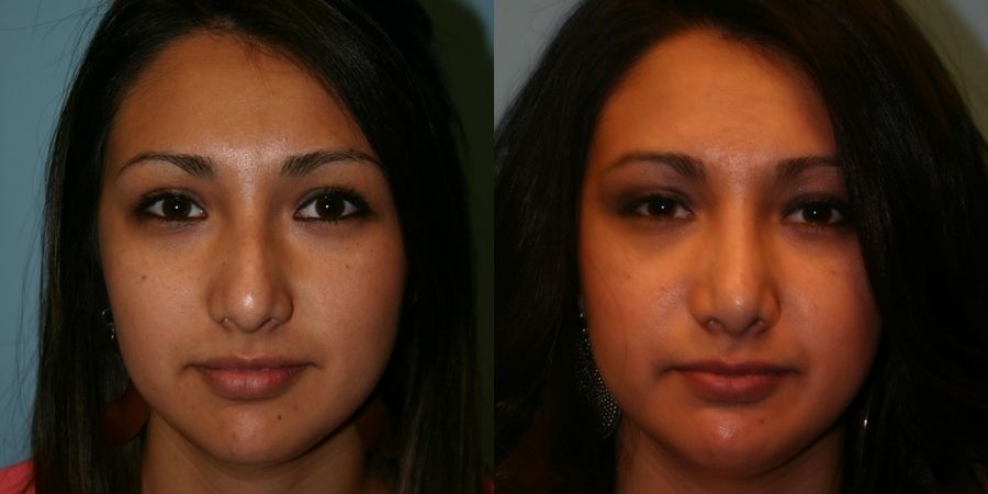 Rhinoplasty - Thumbnail 2