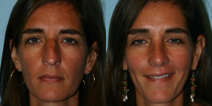 Rhinoplasty - Thumbnail 3