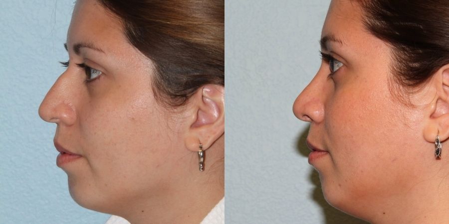 Rhinoplasty - Thumbnail 3