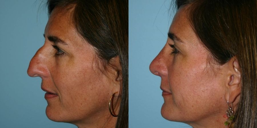 Rhinoplasty - Case 19436