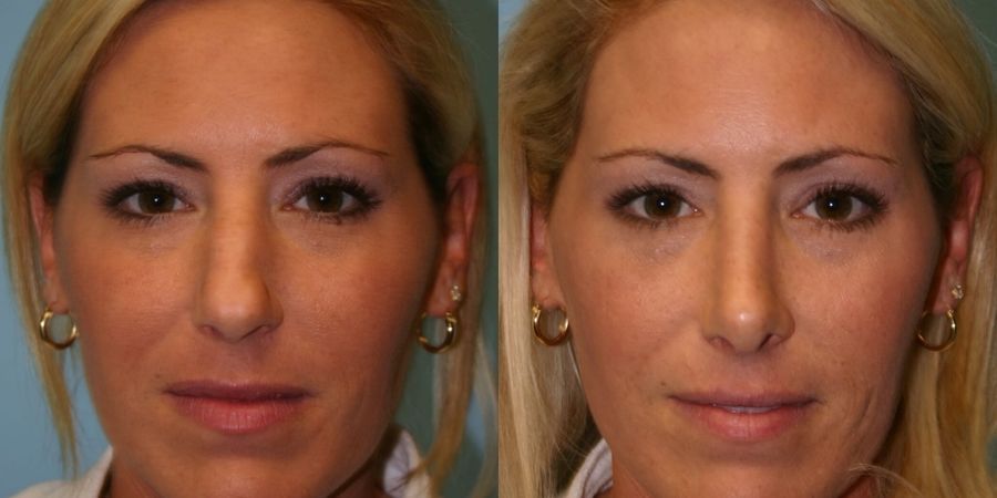 Rhinoplasty - Case 19434