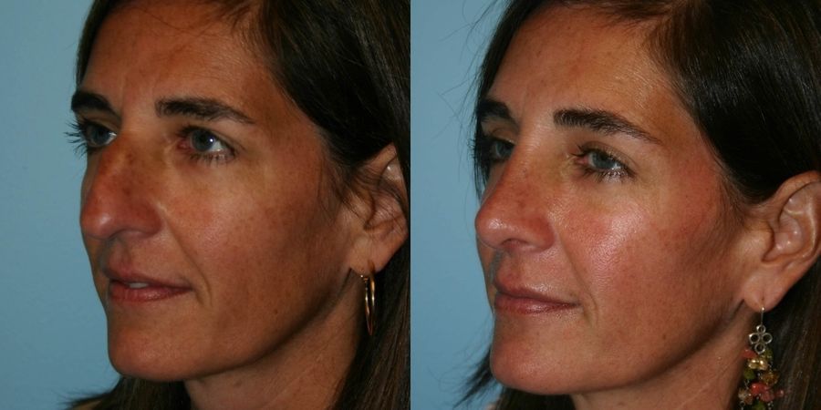 Rhinoplasty - Thumbnail 2