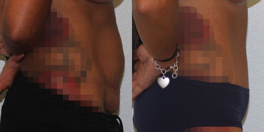 Tummy Tuck - Thumbnail 3