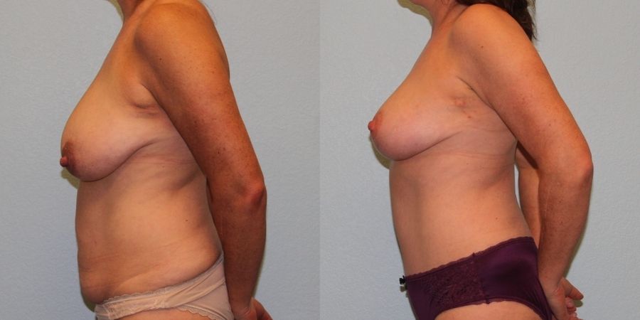 Tummy Tuck - Thumbnail 3