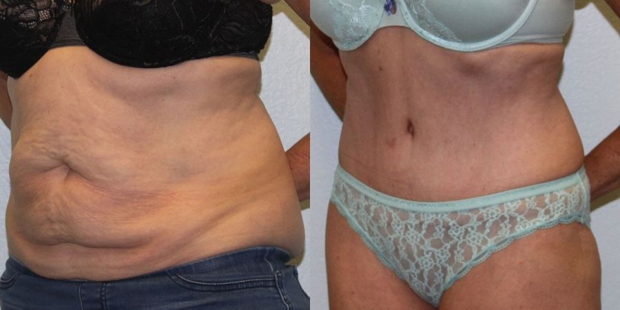 Tummy Tuck - Thumbnail 2