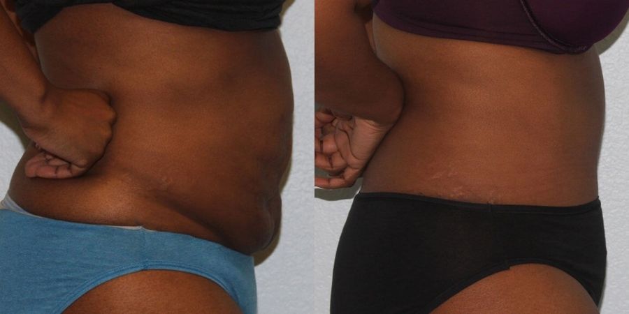 Tummy Tuck - Thumbnail 3