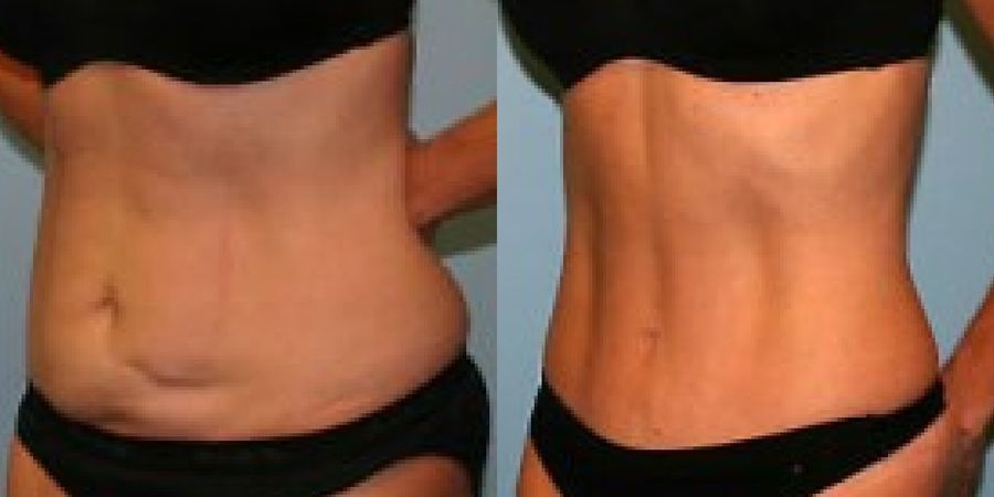 Tummy Tuck - Thumbnail 2
