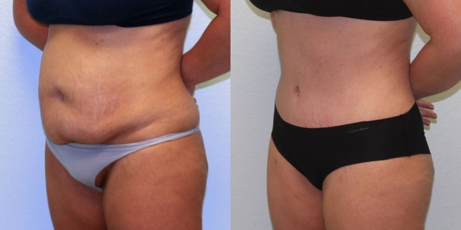 Tummy Tuck - Thumbnail 2