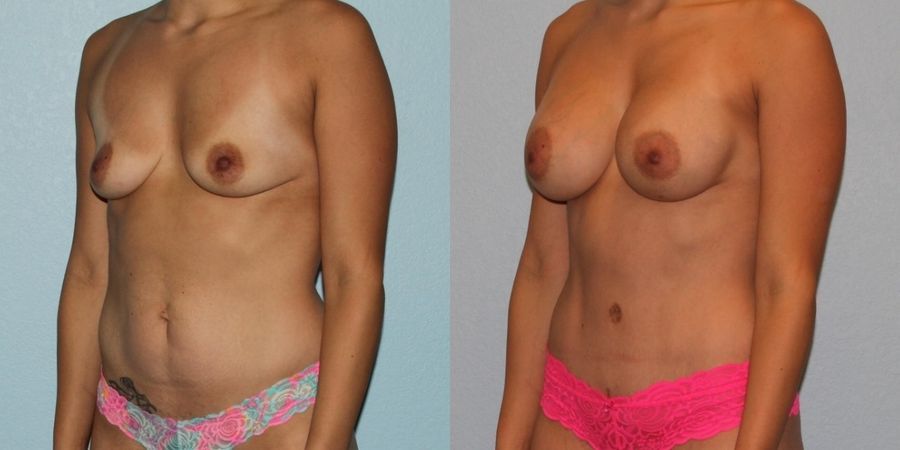 Tummy Tuck - Thumbnail 2