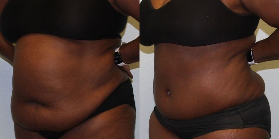 Tummy Tuck - Thumbnail 2