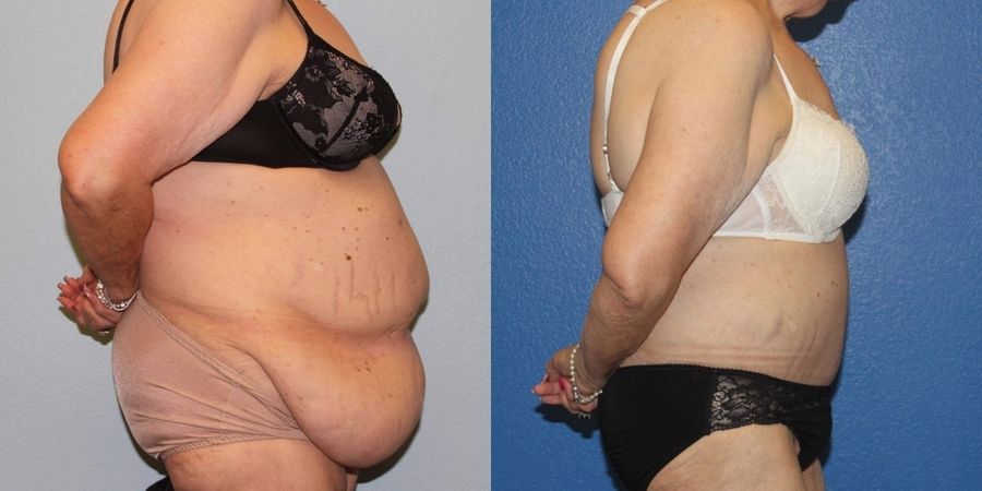 Tummy Tuck - Thumbnail 3