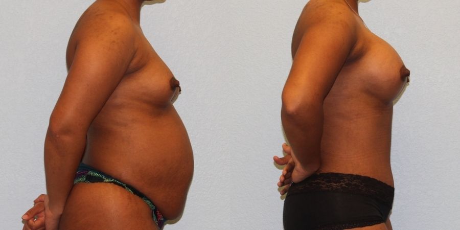 Tummy Tuck - Thumbnail 3