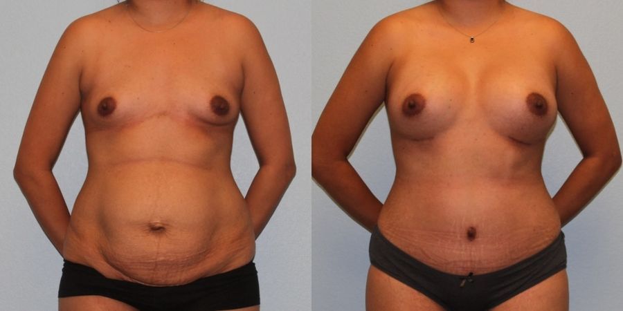 Tummy Tuck - Case 19201