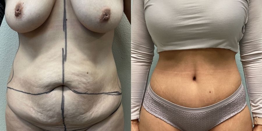 Tummy Tuck - Case 19248