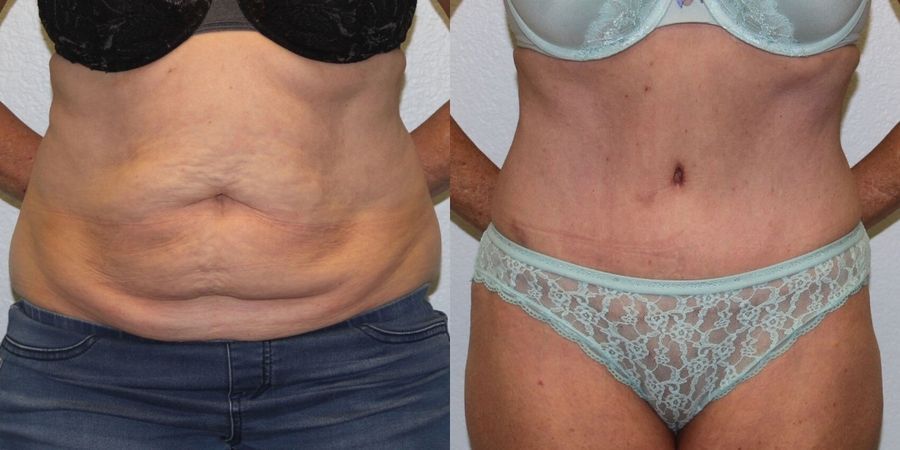 Tummy Tuck - Case 19234