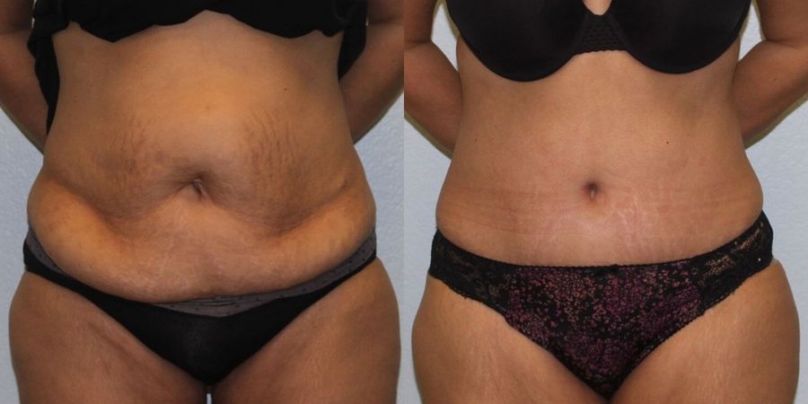 Tummy Tuck - Case 19224