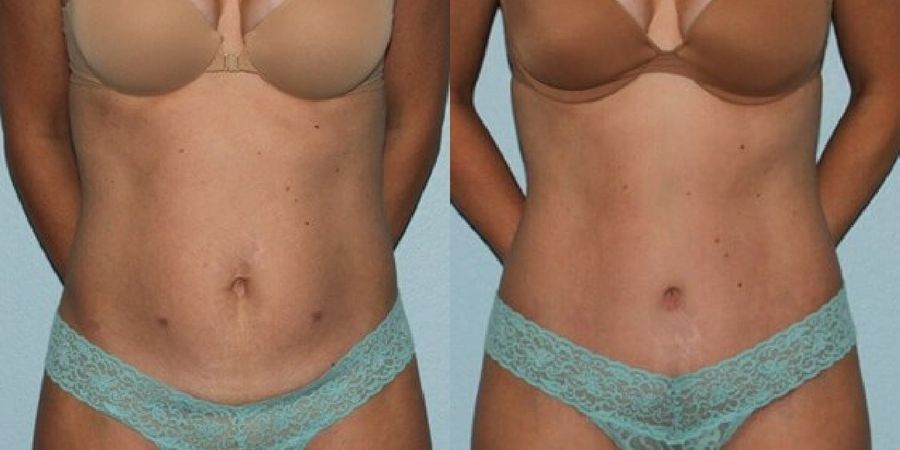 Tummy Tuck - Case 19219