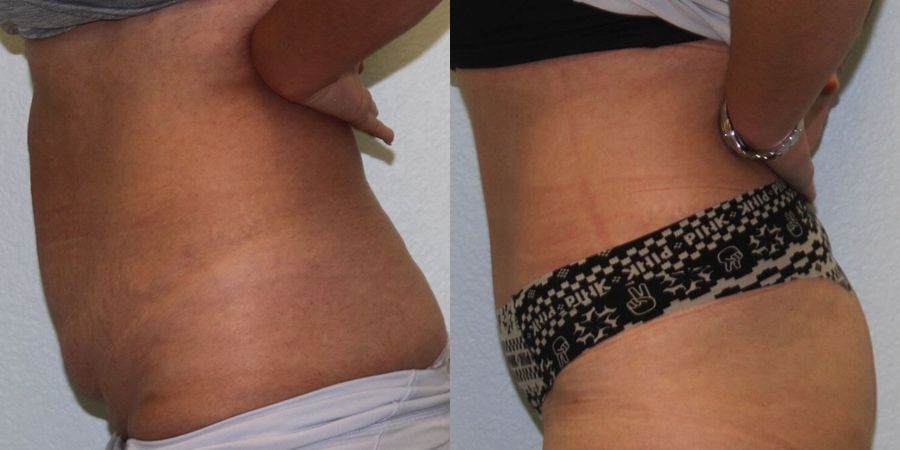 Tummy Tuck - Thumbnail 3