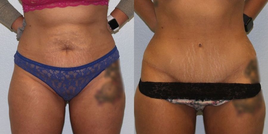 Tummy Tuck - Thumbnail 3