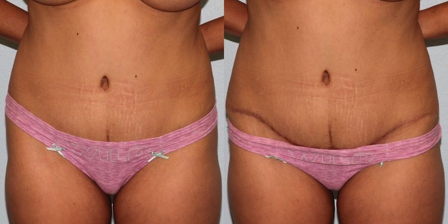 Tummy Tuck - Thumbnail 4
