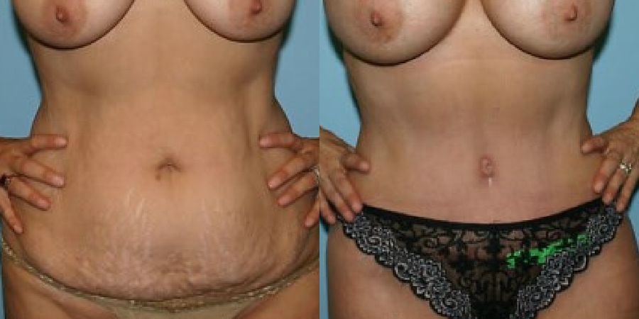 Tummy Tuck - Case 19205