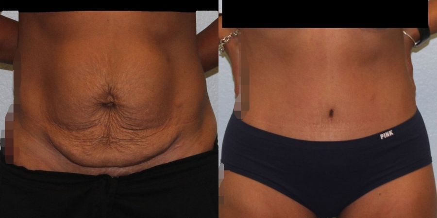 Tummy Tuck - Case 19229