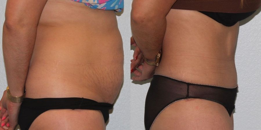 Tummy Tuck - Thumbnail 3