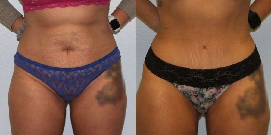 Tummy Tuck - Case 19240