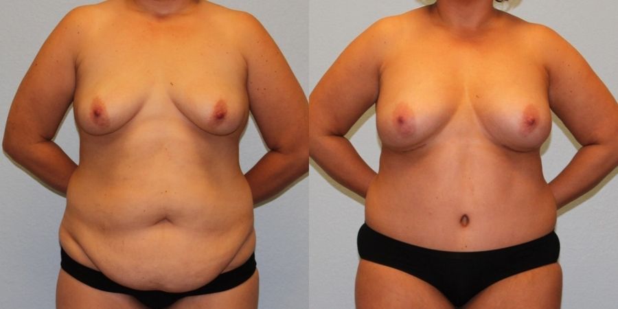 Tummy Tuck - Case 19214