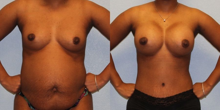 Tummy Tuck - Case 19213