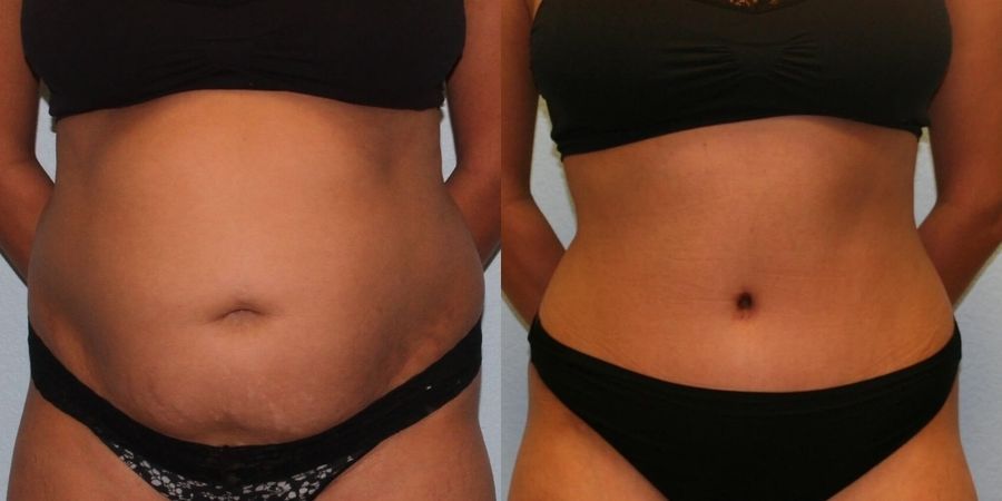 Tummy Tuck - Case 19235