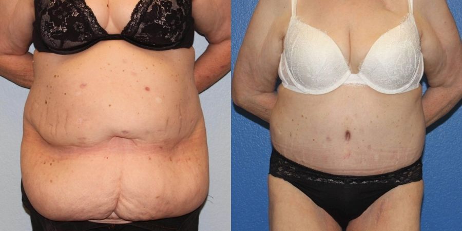 Tummy Tuck - Case 19199