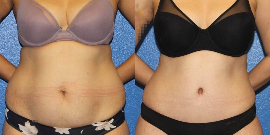 Tummy Tuck - Case 19236