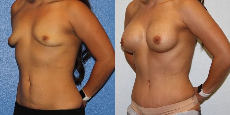 Tummy Tuck - Thumbnail 2