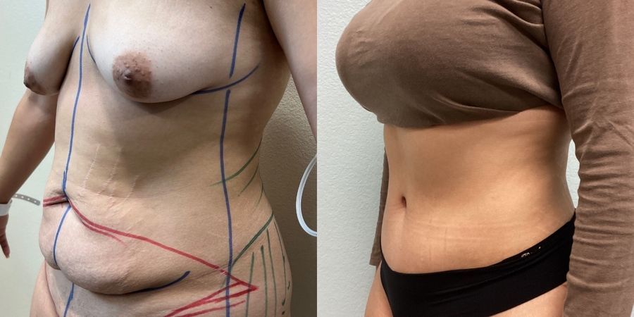 Tummy Tuck - Thumbnail 2