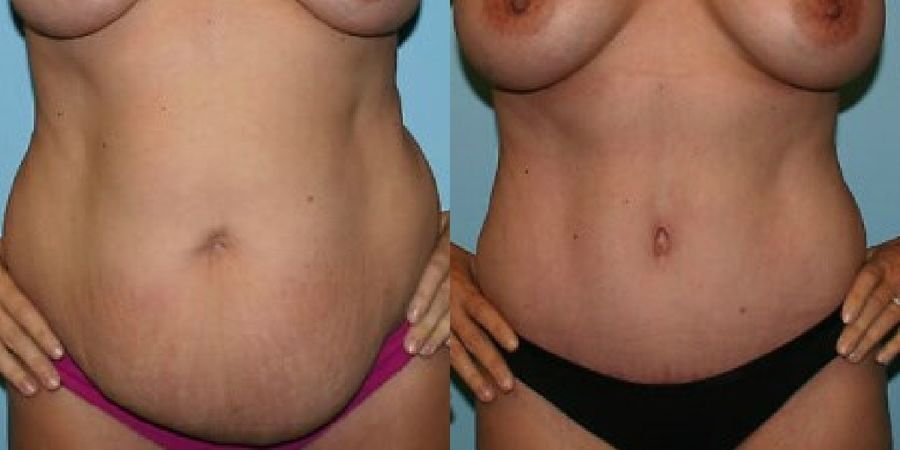 Tummy Tuck - Case 19208