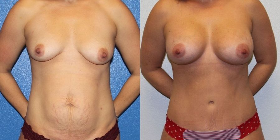 Tummy Tuck - Case 19212