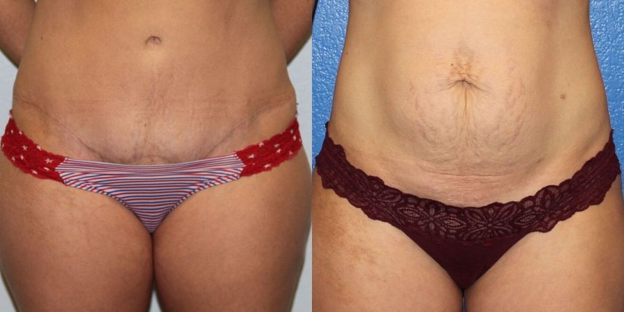 Tummy Tuck - Thumbnail 4