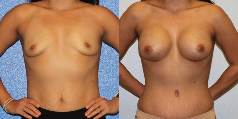 Tummy Tuck - Case 19215