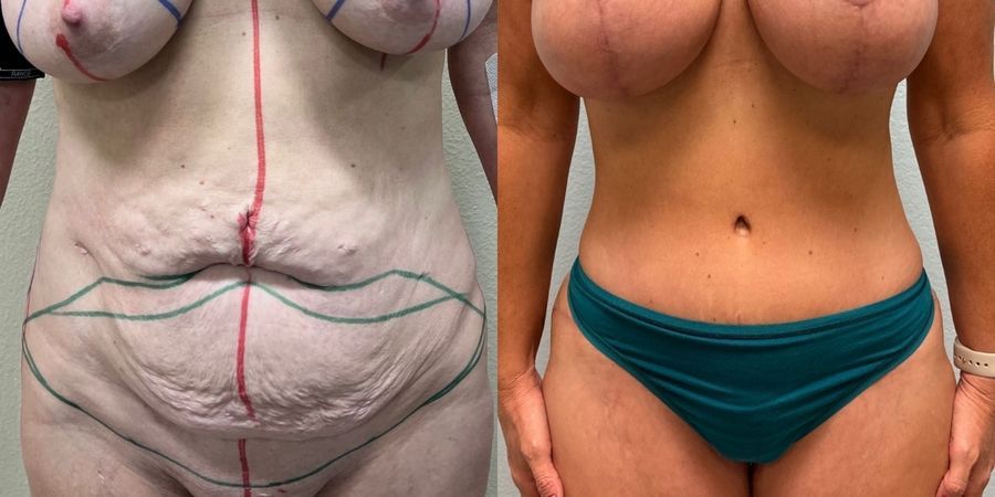 Tummy Tuck - Case 19246