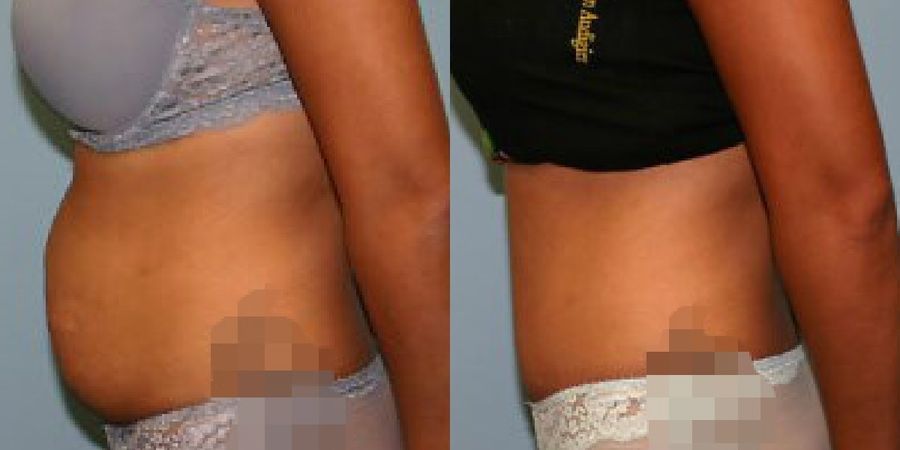 Tummy Tuck - Thumbnail 3